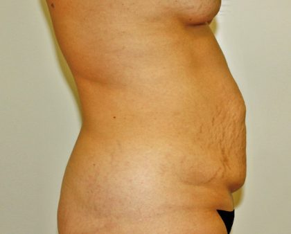 Tummy Tuck Before & After Patient #642