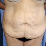 Tummy Tuck Before & After Patient #549