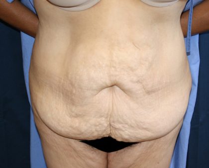 Tummy Tuck Before & After Patient #549