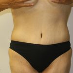 Tummy Tuck Before & After Patient #549