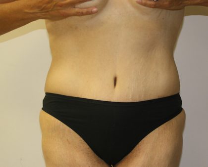 Tummy Tuck Before & After Patient #549