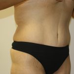 Tummy Tuck Before & After Patient #549