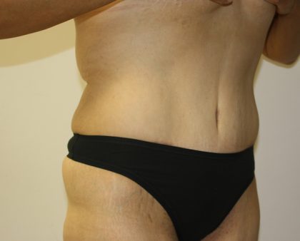 Tummy Tuck Before & After Patient #549