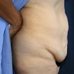 Tummy Tuck Before & After Patient #549