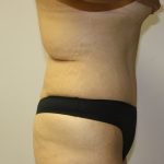 Tummy Tuck Before & After Patient #549