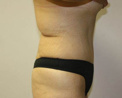 Tummy Tuck Before & After Patient #549