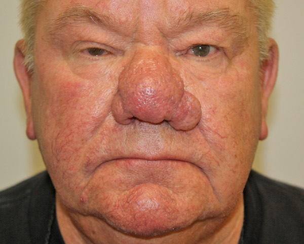 Rhinoplasty Before & After Patient #1345