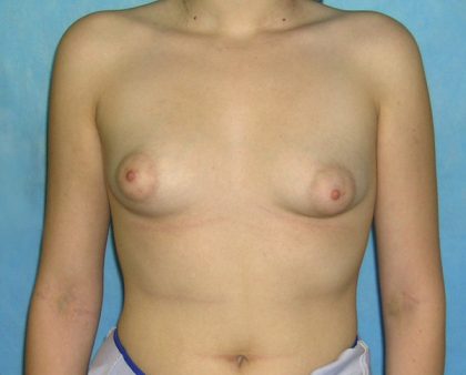Breast Augmentation Before & After Patient #1432