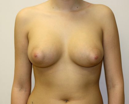 Breast Augmentation Before & After Patient #1432