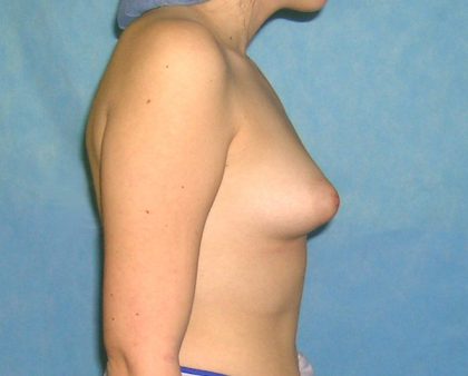 Breast Augmentation Before & After Patient #1432