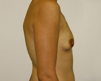Breast Augmentation Before & After Patient #1681
