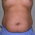 Tummy Tuck Before & After Patient #556