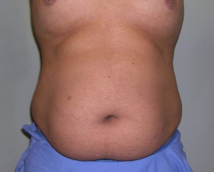 Tummy Tuck Before & After Patient #556