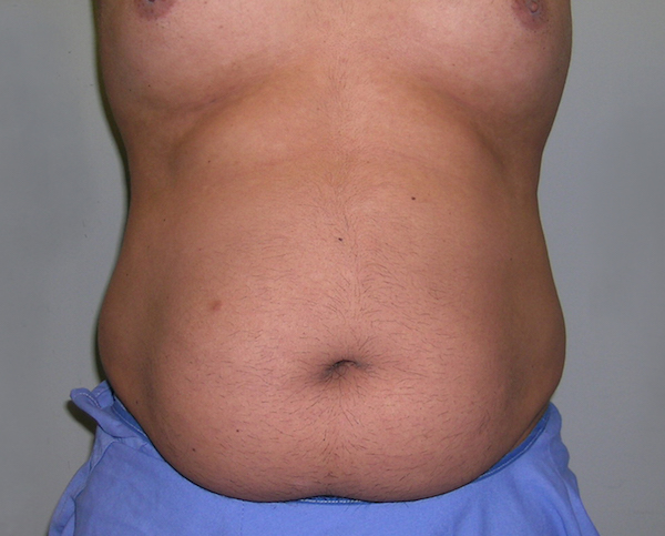 Tummy Tuck Before & After Patient #556