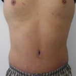 Tummy Tuck Before & After Patient #556