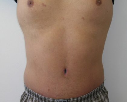 Tummy Tuck Before & After Patient #556