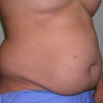 Tummy Tuck Before & After Patient #556