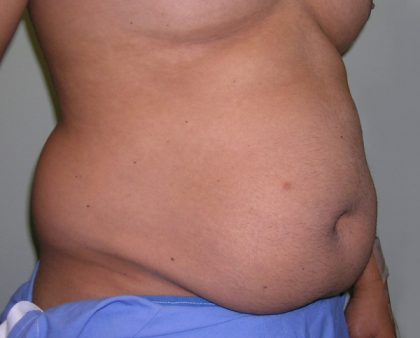 Tummy Tuck Before & After Patient #556