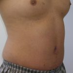 Tummy Tuck Before & After Patient #556