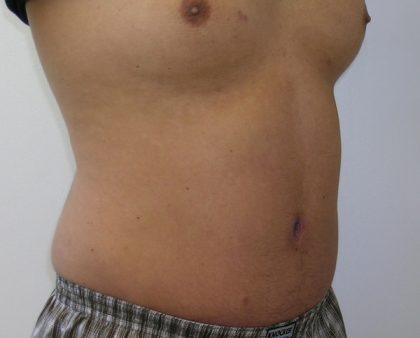 Tummy Tuck Before & After Patient #556