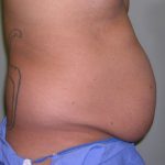 Tummy Tuck Before & After Patient #556
