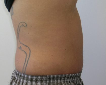 Tummy Tuck Before & After Patient #556