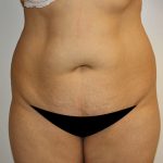 Liposuction Before & After Patient #1120