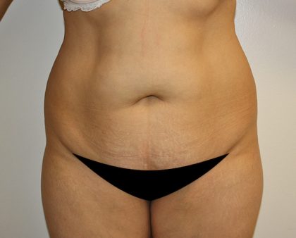 Liposuction Before & After Patient #1120