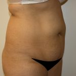 Liposuction Before & After Patient #1120