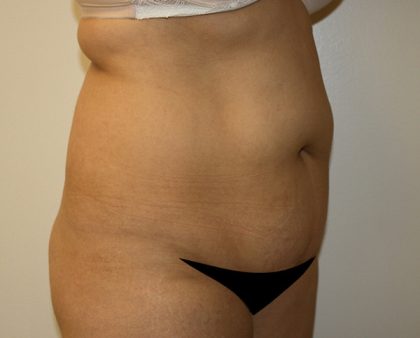 Liposuction Before & After Patient #1120