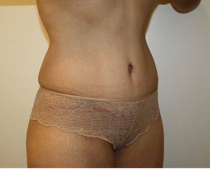 Liposuction Before & After Patient #1120