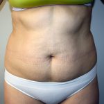 Tummy Tuck Before & After Patient #663