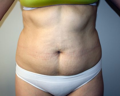 Tummy Tuck Before & After Patient #663