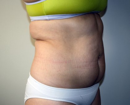 Tummy Tuck Before & After Patient #663