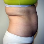 Tummy Tuck Before & After Patient #663