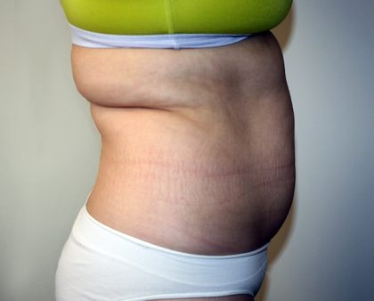 Tummy Tuck Before & After Patient #663