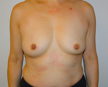 Breast Augmentation Before & After Patient #1468