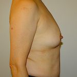 Breast Augmentation Before & After Patient #1468