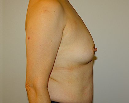 Breast Augmentation Before & After Patient #1468