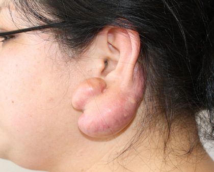 Keloid Surgery Before & After Patient #1100