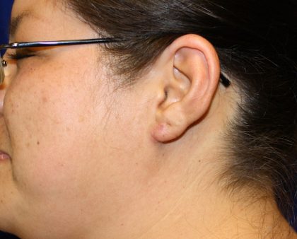 Keloid Surgery Before & After Patient #1100