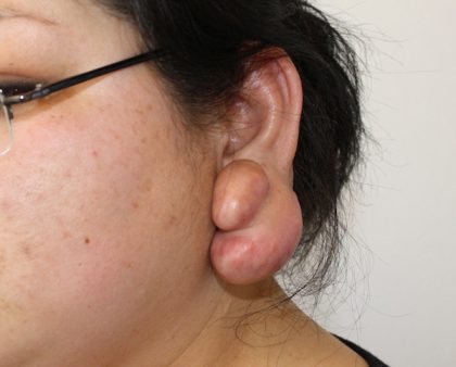 Keloid Surgery Before & After Patient #1100