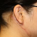 Keloid Surgery Before & After Patient #1100