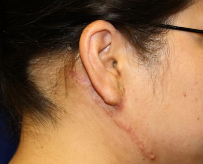 Keloid Surgery Before & After Patient #1100