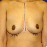 Breast Augmentation Before & After Patient #1439