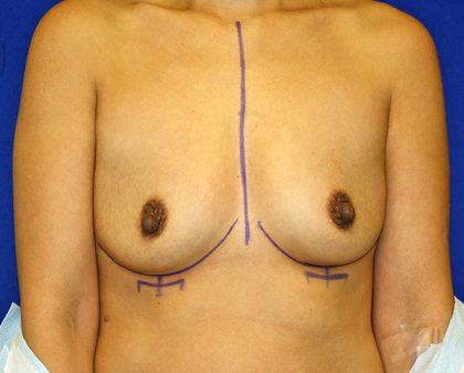 Breast Augmentation Before & After Patient #1439