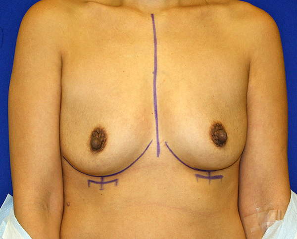 Breast Augmentation Before & After Patient #1439