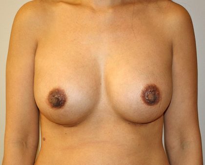 Breast Augmentation Before & After Patient #1439