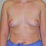 Breast Augmentation Before & After Patient #1709
