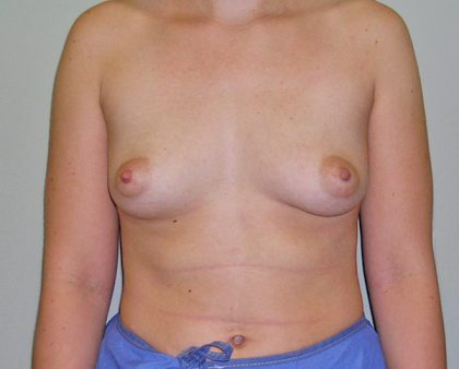 Breast Augmentation Before & After Patient #1709